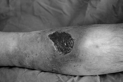 Fig. 5Typical 2-year non-healing venous ulcer of the leg.