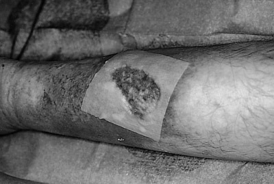Fig. 63-D fibroblast graft.