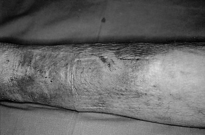 Fig. 7Post-graft results after 30 days.
