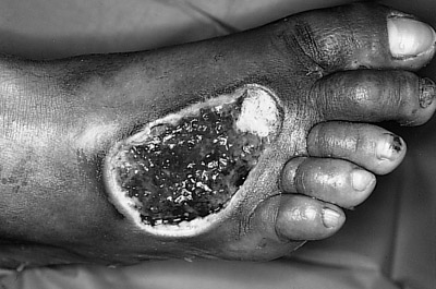 Fig. 8Non-healing diabetic ulcer. Situation after 2 years.