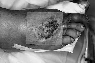 Fig. 93-D fibroblast graft after ulcer preparation.