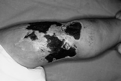 Fig. 11Post-traumatic thigh in 23-month female.