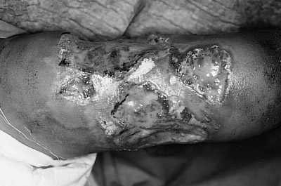 Fig. 12After 10th day post-escharectomy.