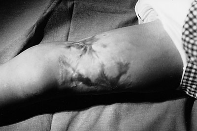 Fig. 14Post-graft results after 30 days. Scar treatment begins.