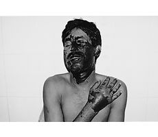 Fig. 1bVictim of acid burn: 32-yr-old male, day 4 post-burn before colonization of bacteria