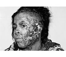Fig. 323-yr-old girl, victim of acid burn due to refusal of love affair. Patient came late width infected wounds