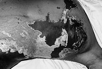 Fig. 4aGirl of 21 yr, victim of acid burn, due to refusal of incident proposal. Acid burn over chest and breast