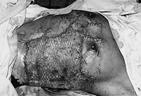 Fig. 4bEarly excision and split-thickness skin graft over chest with reconstruction of breast