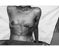 Fig. 4cFollow-up after two weeks (chest and breast)