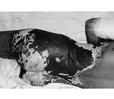 Fig. 4dAcid burn over back, buttock, and thighs