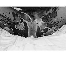 Fig. 4eBurn of perineal region and genitalia