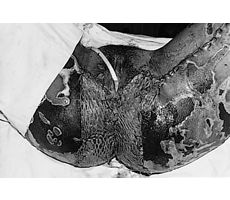Fig. 4fEarly excision and split-thickness skin graft over perineal and genitalia