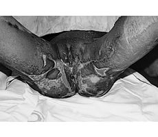 Fig. 4gFollow-up after two weeks (perineal region and genitalia)