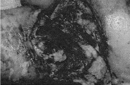 Fig.2Groin and lower abdominal area after surgical debridement