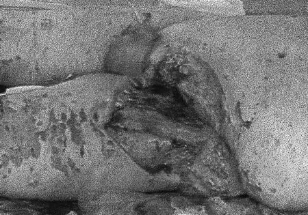 Fig.3Necrotizing area around umbilicus