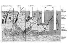 Fig. 1'Rule of nine' in adults and in chilfren of different age groups in relation to percentage area of burned body surface.