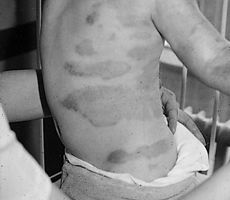 Fig. 3Burn wounds with covering of sterile, fresh-frozen porcine skin as a collagenate forming a primary wound dressing. With porcineskin, paintful daily dressing changes become unnecessary: essenttially it provides additional prevention against infections by adhering to the wiund area.