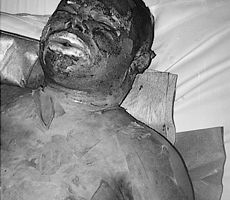 Fig. 4Tender burn scars after coverage of burn wounds with MEDISKIN - a collagene of fresh, sterile, frozen porcine skin.