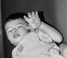 Fig. 1Contact burn from curling iron on childs's hands