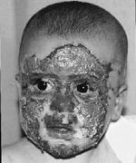 Fig. 1Case 1. Face burns covered with Jaloskin.