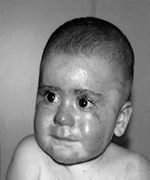 Fig. 3Results after treatment with Jaloskin.
