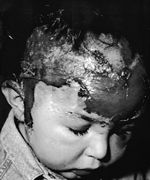 Fig. 4Case 2. Burns caused by boiling water.