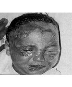 Fig. 7Case 3. Second-degree face burns.