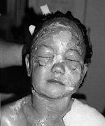 Fig. 8After application of Jaloskin.