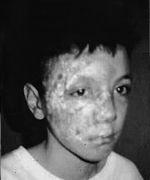 Fig. 10Case 4. Burns covered with Sofargen.