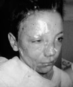 Fig. 11After dressing with Jaloskin.
