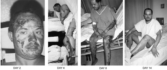 Fig. 1Patient #2 (R.F.), 32 yr, 40%.