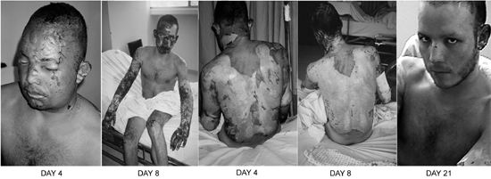 Fig. 2Patient #3 (A.S.), 19 yr, 45%.