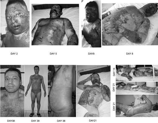 Fig. 3Patient #4 (E.A.), 31 yr, 83%.