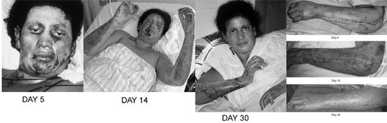 Fig. 5Patient #6 (C.V.), 35 yr, 40%.