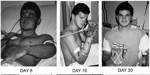 Fig. 6Patient #7 (A.N.), 17 yr, 30%.