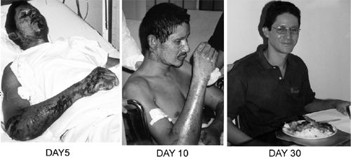 Fig. 7Patient #8 (C.A.P.), 34 yr, 32%.