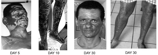 Fig. 8Patient #9 (A.S.), 30 yr, 35%.