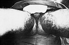 Fig. 1Calcium hydroxide burns