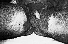Fig. 2Calcium hydroxide burns