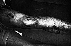 Fig. 3Calcium hydroxide burns