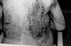 Fig. 1Full-thickness burn on patient's back after split-thickness skin graft