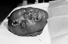 Fig. 2Full-thickness burn on the face after contact with a radiator