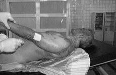 Fig. 1Non infected II-IIIA degree burn wounds &nbsp