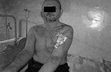 Fig. 2Non infected II-IIIA degree burn wounds on day 7 of tratment with Avtivex-ChL dressings