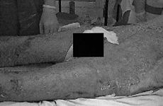 Fig. 4IIIB degree burns on day 2 of treatment with Activetex-ChF dressings.