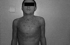 Fig. 6Patient on day 4 after initiation of treatement of residual wounds with Activetex-ChHap dressings.