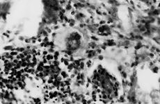 Fig. 2Granulation tissue on day 4. Neovascularization intermingled with lymphocytes, plasma cells, and polymorphonuclear leukocytes in left corner (x 400, H & E).