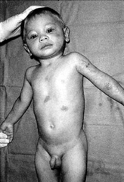 Fig. 2Results after 30 days' treatment with Contractubex� gel.