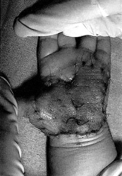 Fig. 3Fresh palmar autograft.