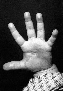 Fig. 4After 60 days' treatment with Contractubex� gel.